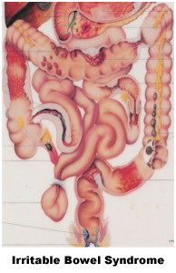 El síndrome del Intestino Irritable y la fibra soluble (IBS)